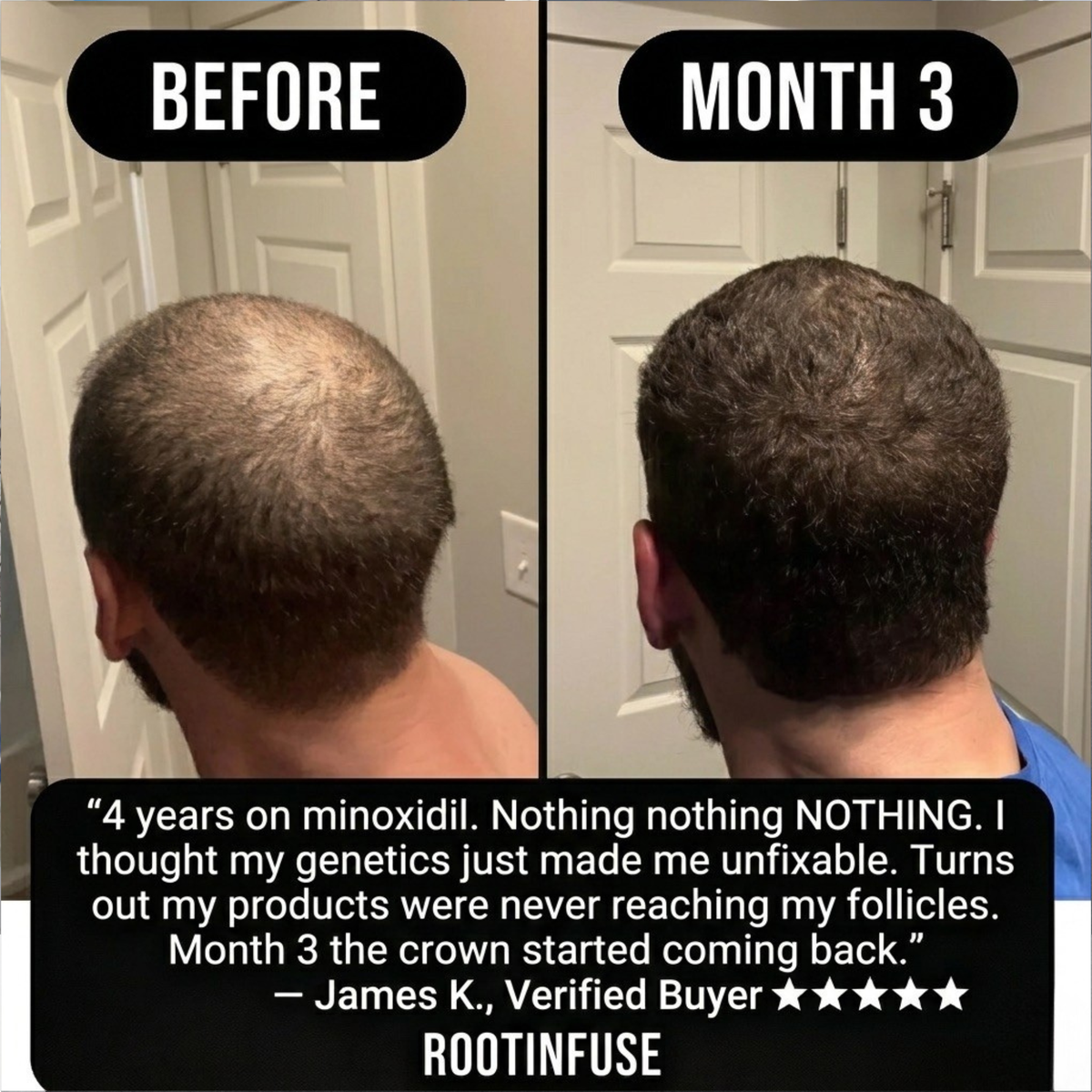 RootInfuse Hair Regrowth System