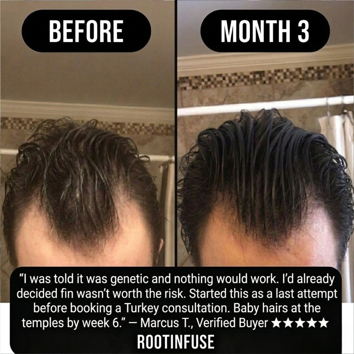 RootInfuse Hair Regrowth System