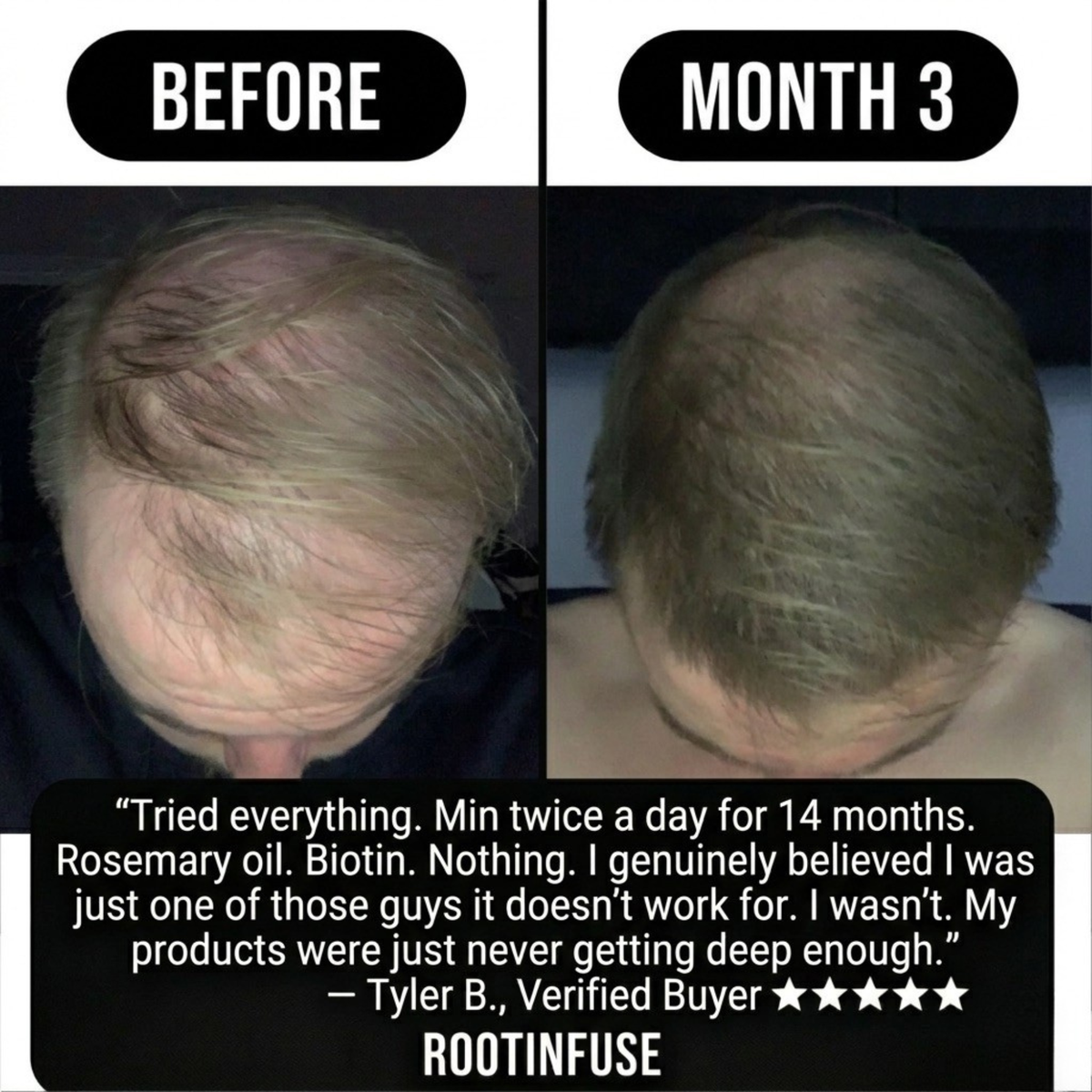 RootInfuse Hair Regrowth System