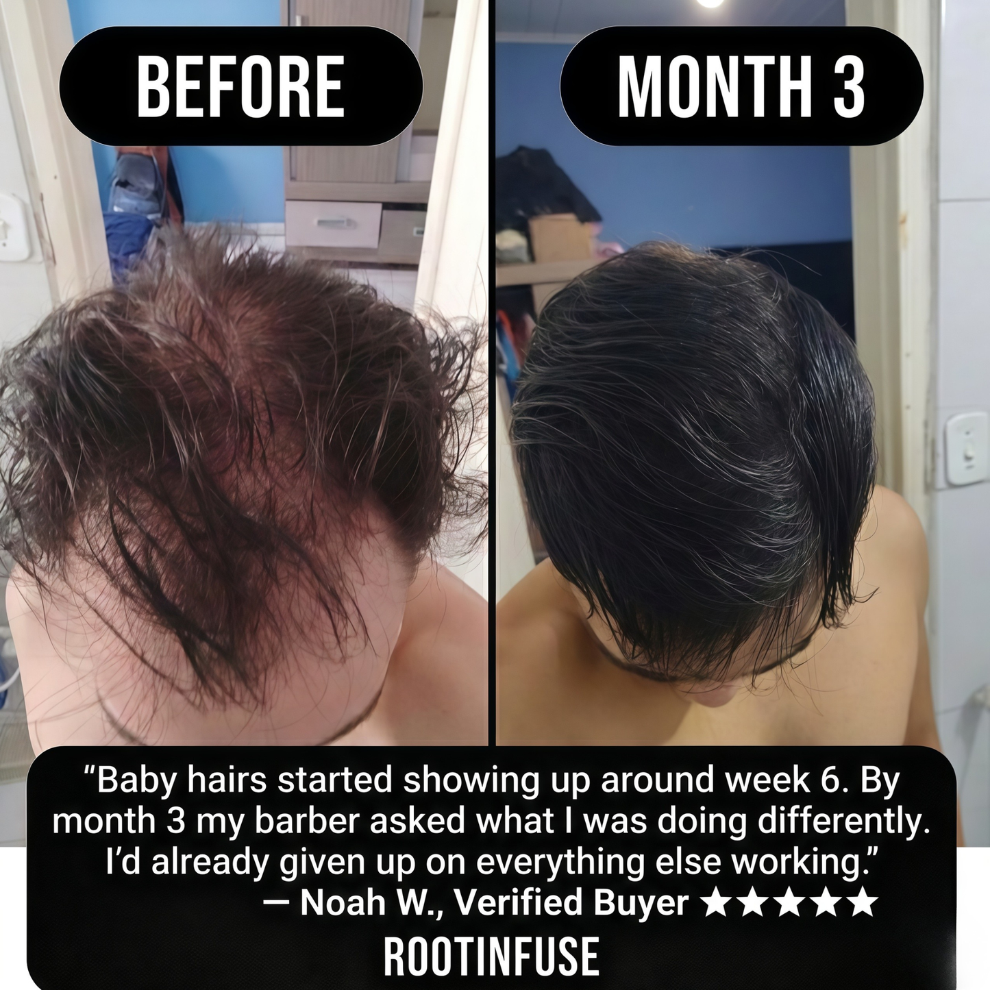RootInfuse Hair Regrowth System